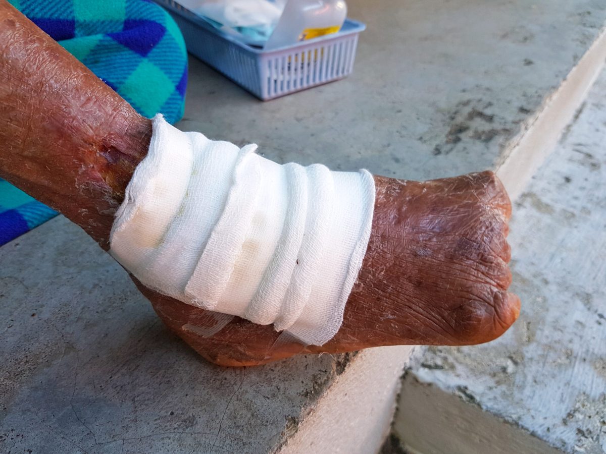Vecteezy left foot of leprosy woman with gauze 3088405 scaled.jpg