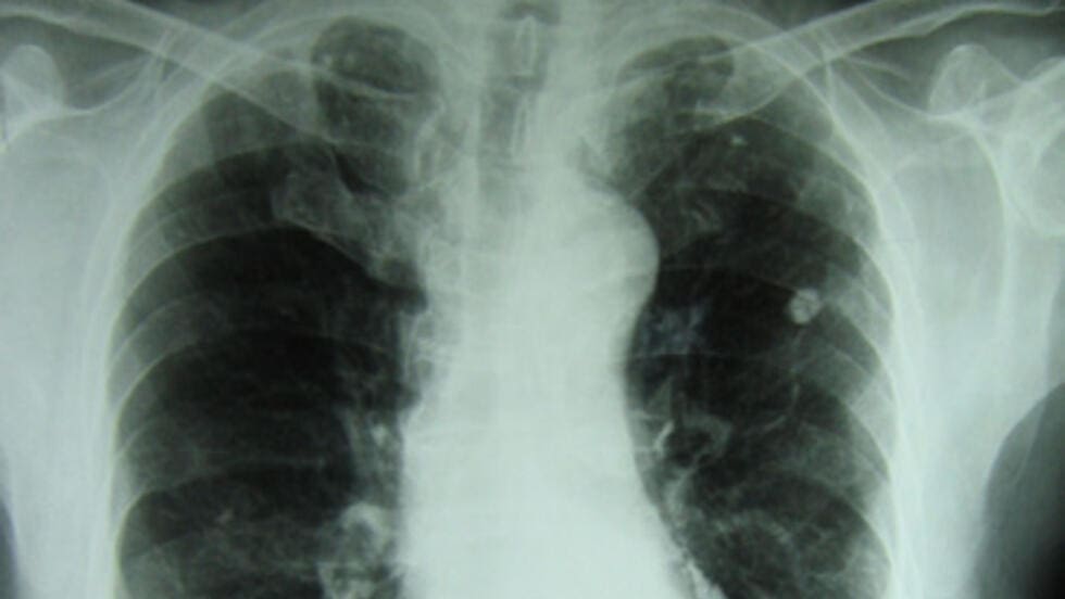 MOCAMBIQUE ENTRE OS PAISES MAIS AFECTADOS PELA TUBERCULOSE.jpg